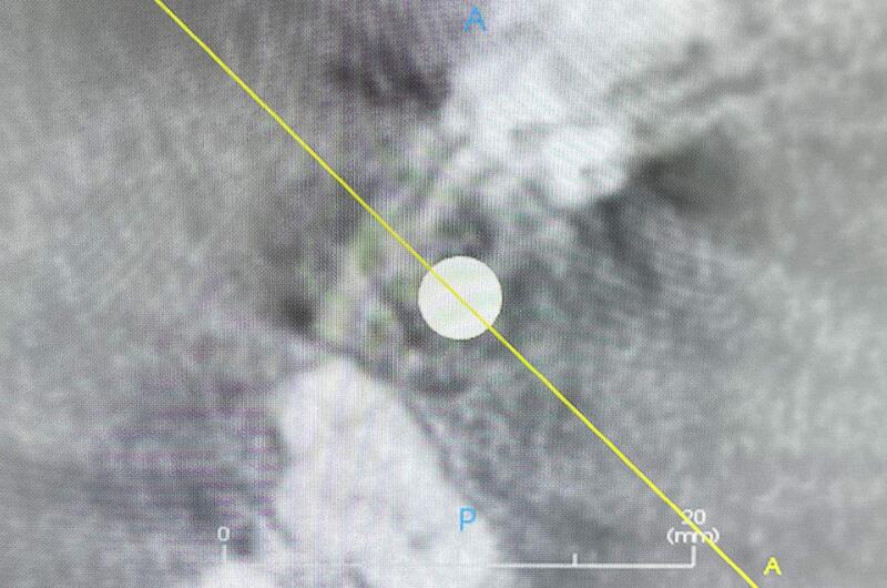 Name:  Implant Screw 1.jpg
Views: 198
Size:  62.0 KB