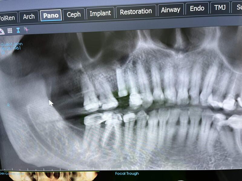 Name:  Actual Implant 1.jpg
Views: 152
Size:  60.3 KB